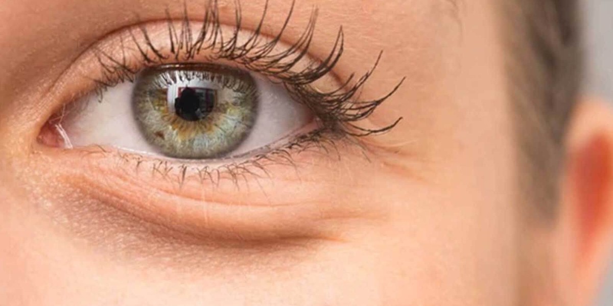 Upper Eyelid Surgery in London: Understanding Different Surgical Techniques