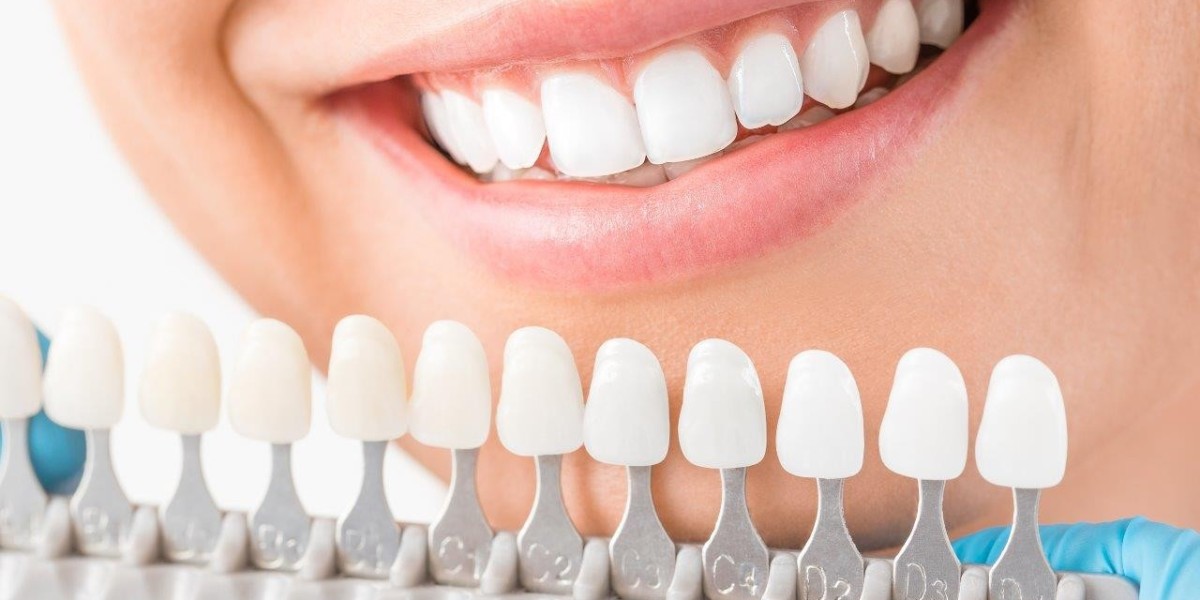 Veneers Dubai: How Dental Veneers Transform the Appearance of Your Smile